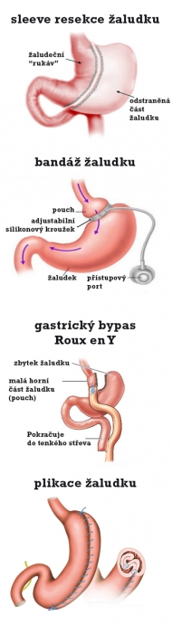 Chirurgické řešení obezity