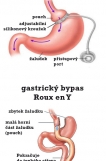=== Obezita ===
Jedním z ukazatelů je BMI. Jak jste na tom si můžete spočítat na kalkulátoru hubnutí zcela vpravo.
Obezita I stupně(mírná) BMI 30 – 35  
Obezita II stupně(střední) BMI 35 - 40 
Obezita III stupně (morbidní) BMI nad 40
Další jednoduché zjištění začínající obezity je podle měření obvodu pasu:
ženy nad 80 cm nad 88 cm 
muži nad 94 cm nad 102 cm

==== neovlivnitelné příčiny obezity ====
• genetické dispozice (25 %)
• schopnost spalovat tuky a cukry 
• aktivita enzymů tukového metabolismu 
• citlivost k inzulinu 

==== ovlivnitelné příčiny obezity ====
• těhotenství 
• laktace 
• disbalance mezi energetickým příjmem a výdejem

Tyto 3 poslední rizikové faktory můžeme ovlivnit správnou a vyváženou stravou. Je třeba myslet na to, že již mírný váhový úbytek(5-10 %) přináší snížení počtu a intenzity zdravotních komplikací, a tím i značné zlepšení kvality života. 

Nezapomeňte, že chirurgické řešení, je až to nejkrajnější řešení, kdy selžou klasické metody redukce váhy i za pomoci farmakologické stimulace.

=== Sleeve resekce žaludku ===
Sleeve resekce žaludku, neboli tubulizace žaludku je restrikční operační zákrok, jenž se provádí v celkové anestezii laparoskopicky a spočívá ve zmenšení žaludku o 70-85%. Operace trvá obvykle kolem 2 hodin. Podélně se přeřeže a přešije v celé délce vakovitý dutý orgán tak, aby tvořil jenom trubici nebo rukáv. Resekční linie v délce v délce cca 30 cm začíná cca 6-7 cm před pylorem a končí hned na přechodu jícnu v žaludek, těsně pod bránicí.

Operací se nejenom sníží kapacita žaludku jako rezervoáru, ale sníží se až vymizí pocit hladu nalačno. Porce jídla se dramaticky sníží a pacient hubne, v rychlejším tempu a ve větší míře než je tomu u bandáže žaludku. Pacienti obvykle snáší pooperační období bez větších potíží, kvalita života se výrazně zlepší.

Na rozdíl od adjustabilní bandáže není Sleeve resekce žaludku regulovatelná ani metoda, která umožňuje opertivní návrat k původní podobě žaludku.

=== Bandáž žaludku ===
Gastrická bandáž žaludku se provádí laparoskopicky v celkové anestezii, během operace se nemusí z břišní dutiny nic odstraňovat a nemusí se otevírat trávící trakt. Podstatou operace je přiškrcení horní části žaludku, takzvanou bandáží. Používá adjustabilní silikonový kroužek, na jehož vnitřní straně je balonek, jehož objem lze regulovat pooperačně vpichem speciální jehlou přes kůži do komůrky v podkoží. Komůrka je spojena pomocí plastové hadičky s balonkem. Míra přiškrcení žaludku závisí na objemu balonku bandáže. 

Přiškrcení horní, vstupní části žaludku vede k tomu, že již po prvních soustech jídla dochází k subjektivnímu pocitu pacienta, že má plný žaludek. Chuť k jídlu se nesníží, ale za pomoci implantované bandáže se nedostavuje pocit nezvládnutelného hladu. Tlak balonkové manžety na nervová zakončení v horní části žaludku signalizuje mozkovým centrům pocit plného žaludku. 

Dietologické usměrnění umožňuje snížit denní dávky stravy bez velkého trápení hladem, bez trýznivého pocitu prázdného žaludku na takovou míru a na tak dlouhou dobu, jaká by nebyla bez operace dosažitelná. Postupně dochází k úpravě hladiny cukru v séru, konkrétně při ztrátě 30 kg z nadváhy je riziko diabetu II typu sníženo 14-ti násobně. Dochází i ke snížení hypertenze, i když v trochu menší míře. Snížení váhy zmírňuje potíže s klouby a umožňuje fyzickou aktivitu, zvýšený výdej energie. Váhový úbytek v průměru přesahující 35 kg trvá při dlouhodobém sledování i více než 5 let po operaci.

=== Gastrický bypas Roux en Y ===
Bypas žaludku je chirurgické rozdělení žaludku na horní menší část a dolní větší část, která zústává vyřazena. Gastrický bypas patří mezi nejůčinnější metody chirurgické léčby obezity a s ní spojených metabolických poruch. Je to laparoskopicky prováděná operace, u které se kombinuje restrikce (zmenšení objemu žaludku) s mírnou malabsorbcí (zmenšením plochy vstřebávání).

Potrava z malé horní části žaludku (tzv. "pouch") se dostává do tenkého střeva, které tvoří rameno cca 150 cm dlouhé a spojuje se s biliopankreatickou kličkou, cca 50 cm dlouhou, vedoucí jenom trávicí šťávy a žluč. Trávenina pak putuje společným ramenem, kde je již umožněno trávení a vstřebávání živin. Střevo tak tvoří tvar písemna „Y“. Při modifikaci s větší délkou (distální gastrický bypas) dochází k výraznější malabsorbci a výraznějšímu hubnutí.

=== Plikace žaludku ===
Laparoskopická plikace žaludku je nová bariatrická operace s restrikčním účinkem. Provádí se laparoskopicky a principem je zmenšení objemu žaludku.

Při plikaci se z organismu nic neodstraňuje,  jenom se jeho stěna zanořuje bez otvírání trávícího traktu do prostoru žaludku a podélně se přešívá nevstřebatelnými stehy. Toto se opakuje 1-3 x podle potřeby, a to v délce 20-30 cm.

Operační zákrok se provádí v celkové anestezii laparoskopicky a trvá obvykle do dvou hodin. Rizika komplikací jsou ve srovnání s jinými restriktivními bariatrickými zákroky nízká, protože se v organismu neponechává žádný implantát z cizího materiálu (gastrické bandáže) ani se neotvírá a neresekuje stěna žaludku (sleeve resekce žaludku, bypas žaludku). Pooperační období vyžaduje intenzivnější péči a pobyt v nemocnici, podobný jako po sleeve resekci, t.j. cca 5 dní, protože zanořená čásť žaludku je zpočátku podrážděná a oteklá. Bývá pravidlem, že pacienti v prvních dnech trpí nutkáním na zvracení a vyžadují medikamentosní tlumení potíží a infusní léčbu.

Plikace tak vede nejenom k poklesu kapacity žaludku, ale i ke snížení schopnosti žaludku rozpínat se při jídle a ke snížení pocitu hladu - podobně jako je tomu po Sleeve resekci. Porce jídla sa dramaticky sníží a pacient hubne podobně rychle jako po Sleeve resekci, rychlejším tempu a zpravidla ve větší míře než je tomu po bandáži žaludku. Míru hubnutí dále pooperačně nelze regulovat, resp. její dobu prodlužovat, jako je to s výhodou možné po adjustabilní bandáži žaludku. Pacienti po Plikaci žaludku, až na navalování v prvních dnech, pak obvykle snáší pooperační období bez větších problémů, kvalita jejich života sa výrazně zlepší.

O vhodnosti chirurgického řešení je vždy třeba poradit se s ošetřujícím lékařem.

Budu všem, kdo potřebují podobné věci řešit, moc držet palce. Nejhorší řešení je rezignovat, vzdát to. I u morbidní obezity je šance vrátit se zpět do plnohodnotného života. Je důležité chtít a hlavně mít podporu nejbližších.